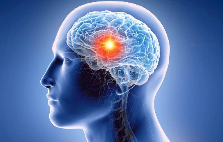 Brain Tumor11