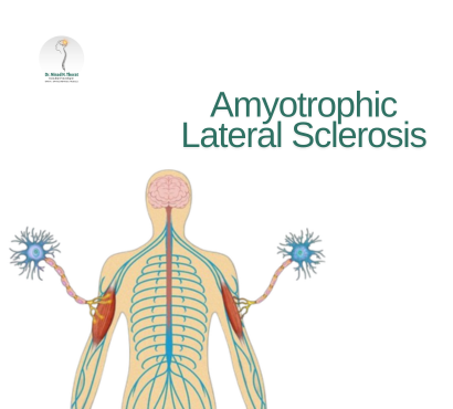 Amyotrophic-Lateral-Sclerosis